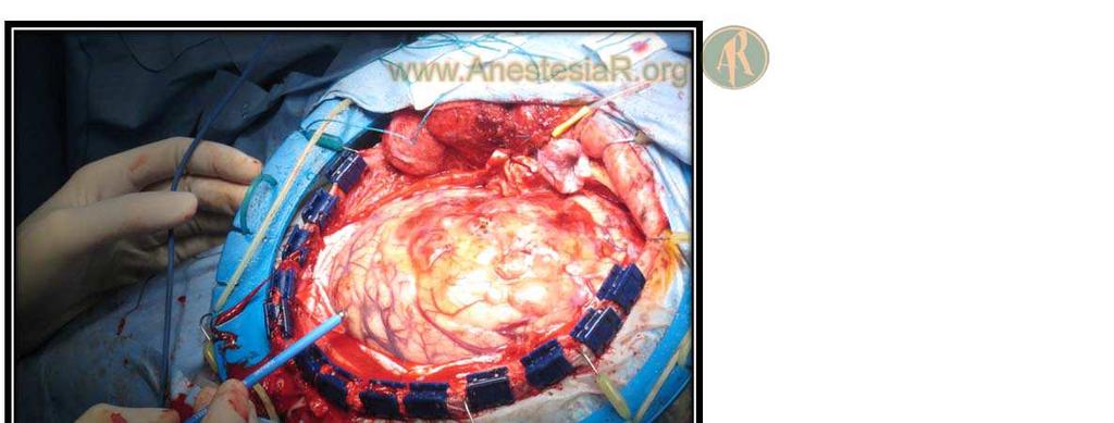 Figura 6.- Mapeo cortical previo a cirugía resectiva tumoral próxima al área de Broca.