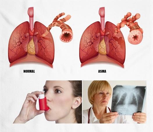Asma: causas, síntomas y tratamientos El asma (Asma bronquial) es una enfermedad común de las vías respiratorias, las estructuras a través de las cuales pasa el aire cuando se transporta de su boca y