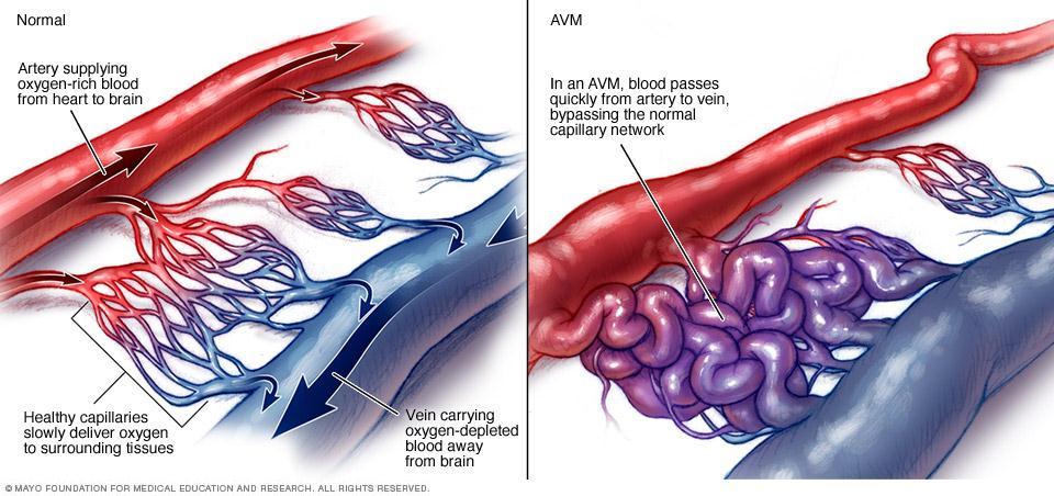 Malformaciones Vasculares 4. Malformaciones arteriovenosas Alto flujo.