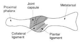 ANEXO 3: Articulación metatarsofalángica que muestra la disposición de los ligamentos colaterales y plantares Referencia: Palastanga N, Field D, Soames RW.