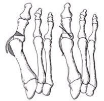 La osteotomía de base medial se localiza en la metáfisis de la falange proximal (área sombreada superior).