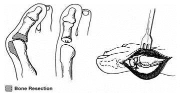 ANEXO 16: Artroplastia metatarsofalángica -Resección a realizar de la eminencia medial y del cuarto proximal de la falange.