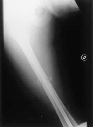 ANEXO 21 Radiografía anteroposterior de fractura transversal de diáfisis femoral tratada con clavo intramedular de kuntcher. REFERENCIA: Navarro García.