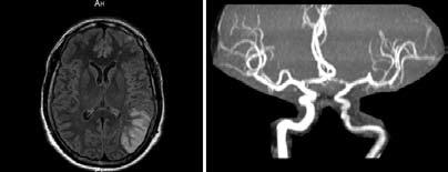 9 BOLETÍN EDUCATIVO SOLACI CASO CLINICO Angioplastia carotídea con sistema de protección proximal MoMa en contexto de accidente cerebro vascular (ACV) isquémico. Reporte de un caso. // Autores: Dres.