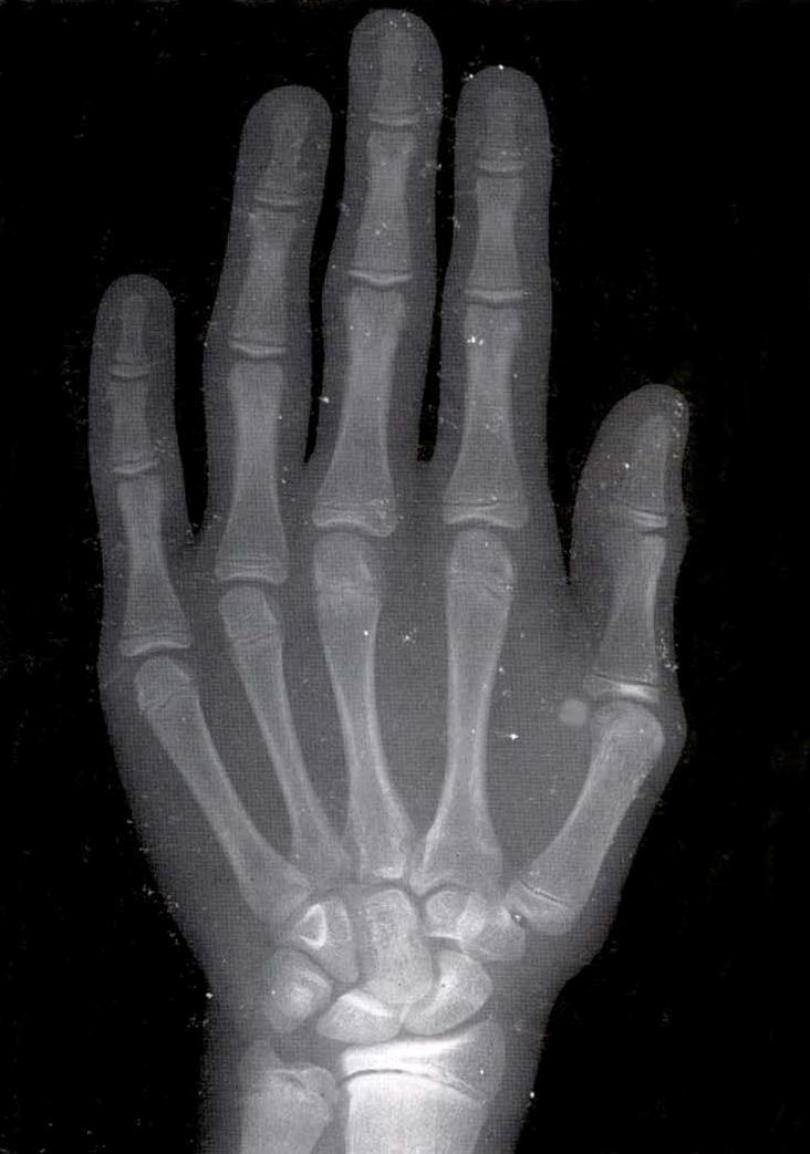 2- Epífisis de la falange proximal del pulgar. 3- Hueso sesamoideo aductor. 4- Epífisis de la falange distal del dedo índice. 5- Epífisis de la falange media del dedo índice.