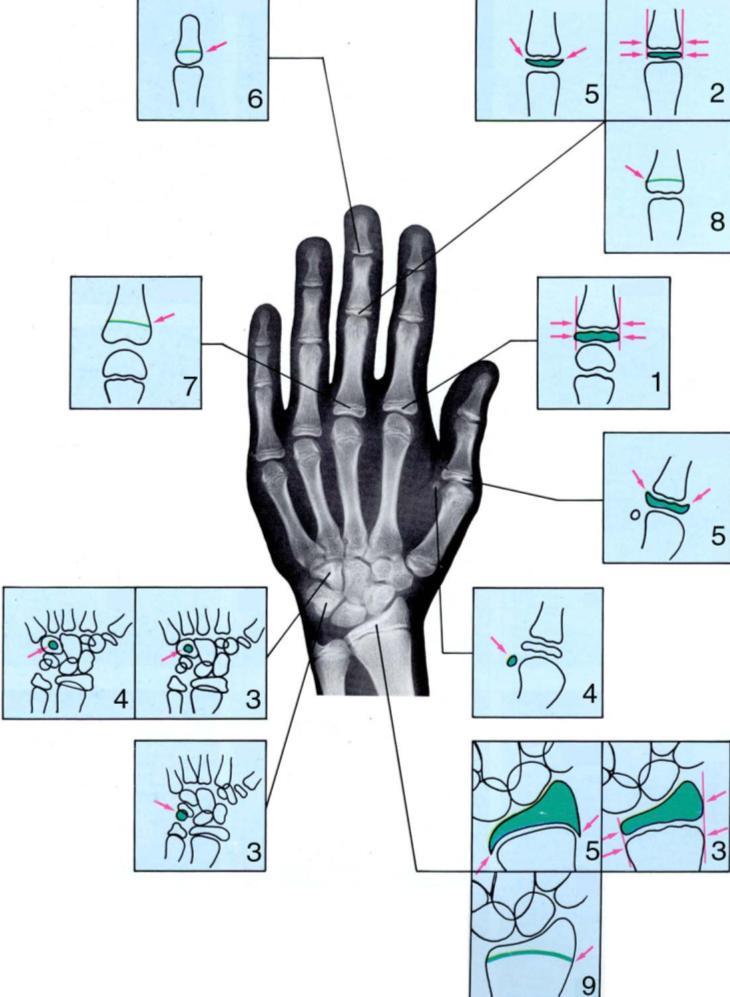 3.2 ANÁLISIS DE BJÖRK ( 1972 ), GRAVE Y BROWN (1976 ) En ortopedia maxilar se ha utilizado el análisis de Björk, 21 el cual divide el proceso de maduración de los huesos de la mano en 9 estadios