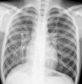 3 El papel de la colateral aorto-pulmonar no está claro en este síndrome, pero se ha postulado que su oclusión puede jugar un papel importante en el tratamiento tanto de la hipertensión pulmonar como