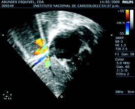 3,9 El término de síndrome de cimitarra deriva de la imagen que se observa en la radiografía de tórax por la conexión venosa anómala parcial que se extiende desde una posición lateral del pulmón