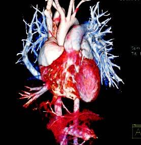 Cateterismo cardiaco en proyección anteroposterior. A.