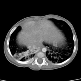 Presencia de colateral de aorta descendente al lóbulo inferior del pulmón derecho. Figura 5. Corte sagital de tomografía computada.