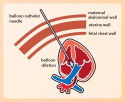 Defectos cardiacos: Cirugía Fetal por abordaje Percutáneo Estenosis Aortica crítica Gran dilatación VI con FE <30% Valvuloplastia