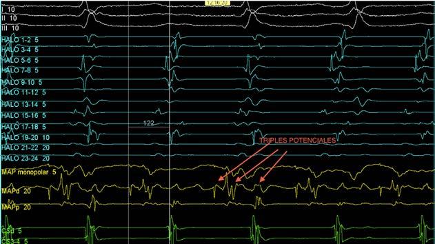 56 Cuadernos de Estimulación Cardiaca Figura 7. Señal intracavitaria en el punto de mayor precocidad (122 msec hasta el inicio de onda P).