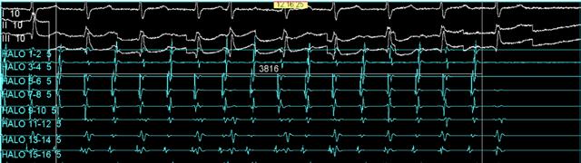 Interrupción de la taquicardia a los 3,8 segundos desde el inicio de la aplicación. I, y I ECG de superficie.