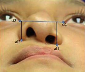 generalmente asociados a desviación del septum nasal (6-7).