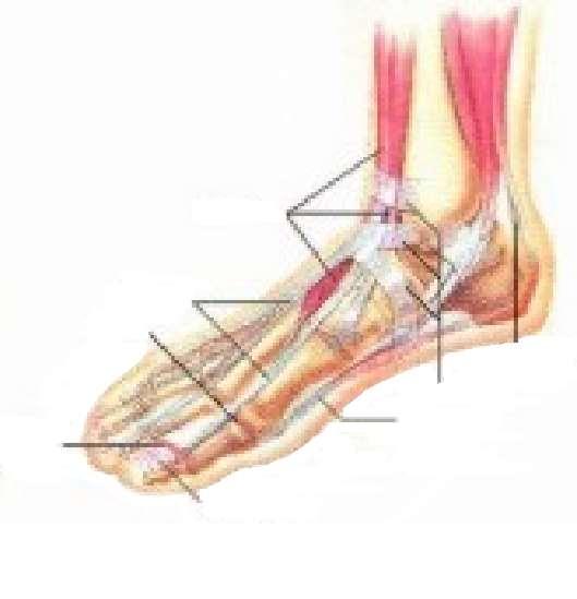 Definición Se define el pie diabético como una alteración clínica de base etiopatogénica neuropática inducida por la hiperglucemia mantenida, en la que, con o sin coexistencia de isquemia y sin