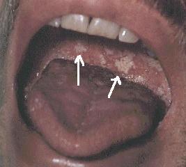 PATOGENIA La candidosis invasora: >colonización n boca, vagina y excremento por candida a causa ATBterapia. Bucofaríngea >riesgo en: 1. RN (bajo peso) 2. Diabetes mellitus 3.