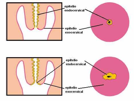 d. ECTROPION. 22 Estado en que el epitelio cilíndrico se evierte sobre el exocervix 19.