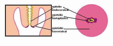 25 Figura 10. Modificación y sustitución de un tipo de epitelio normal generalmente glandular a un segundo tipo de epitelio normal generalmente escamoso.