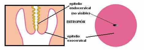 26 ectopia endocervical 22, el cual puede constituirse como la puerta de entrada de algunos virus como el HPV aprovechando que las células básales y parabasales quedan al descubierto 23. f. ENTROPIÓN.