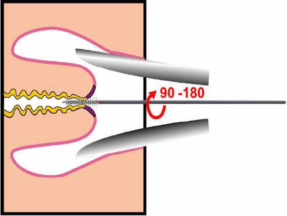 41 Figura 21. El citocepillo debe introducirse en el canal endocervical y girarse ya que tiene cerdas en los 360, con este giro se logra obtener material adecuado de endocervix.