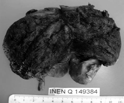 TAC cerebro (izquierda), múltiples calcificaciones periventriculares. ción tumoral de 8.0 x 7.0 x 2.3 cm.