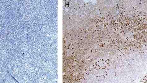 IgM + cases predominance of B cells diffuse
