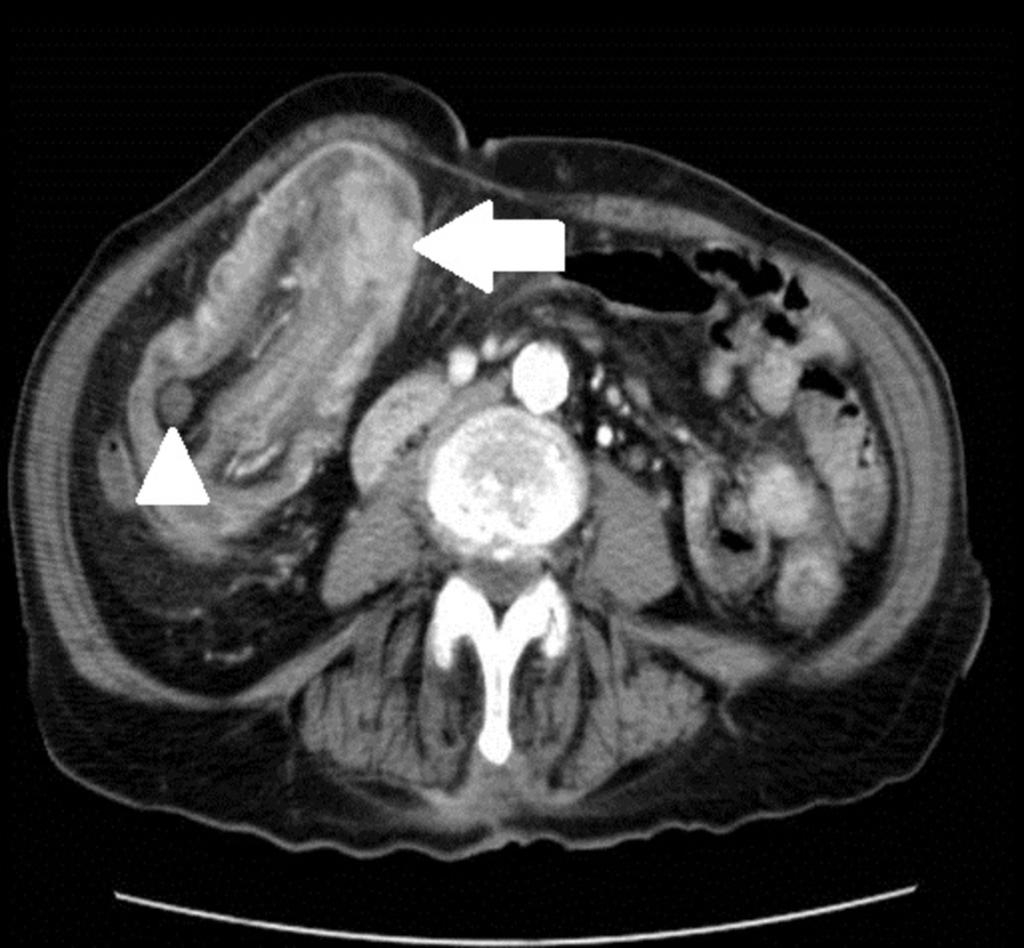 Fig. 21: TC abdómino-pélvico de la paciente anterior. Se confirma la invaginación ileocólica sospechada en la ecografía. El tumor que actúa como punto de arrastre se origina en ciego (flecha).