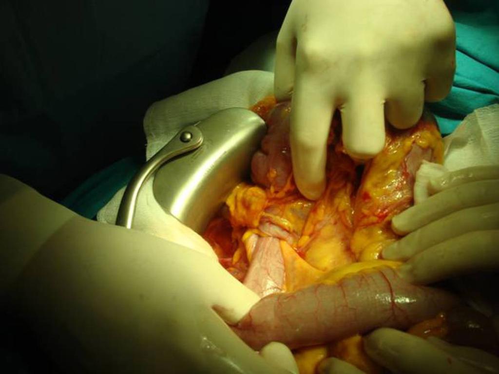 Fig. 16: Imagen intraoperatoria de la paciente anterior en