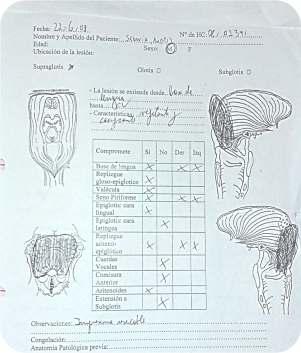 Ingresa al IOAR el 19/06/08 Segovia Andrés Examen físico: cuello: adenopatía de 2cm nivel II derecho. LI: lesión vegetante que obstruye la supraglotisa predominio derecho y posterior.