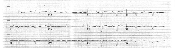 Historia 3 Paciente de 49 años, sexo masculino, sin factores de riesgo cardiovascular. Portador de una miocardiopatía dilatada idiopática. Insuficiencia cardíaca CF II.