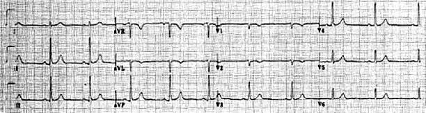 Historia 5 (cont.) Usted es llamado en consulta como cardiólogo de urgencia. Al llegar la paciente ya revirtió su arritmia, se encuentra asintomática y con el siguiente ECG basal.