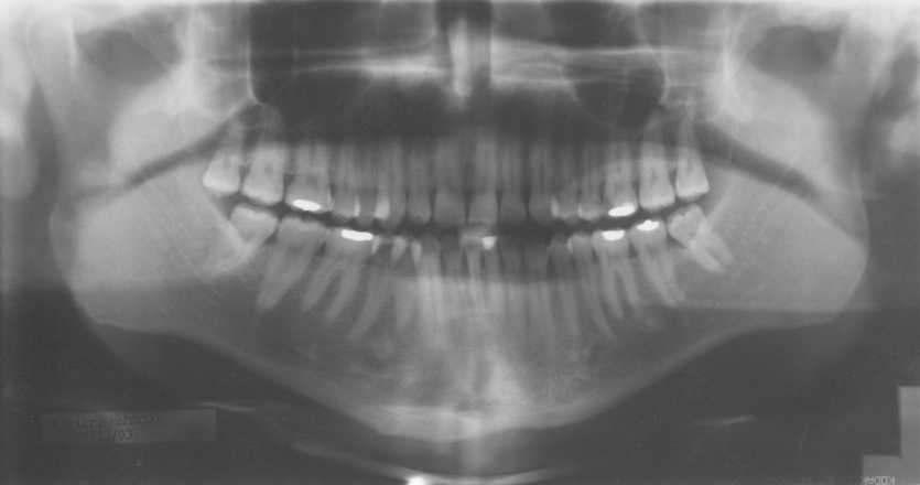 Rotación de la cabeza del paciente Los dientes y estructuras son más pequeños en el lado donde rota la cabeza, (más cercano a la película, hay