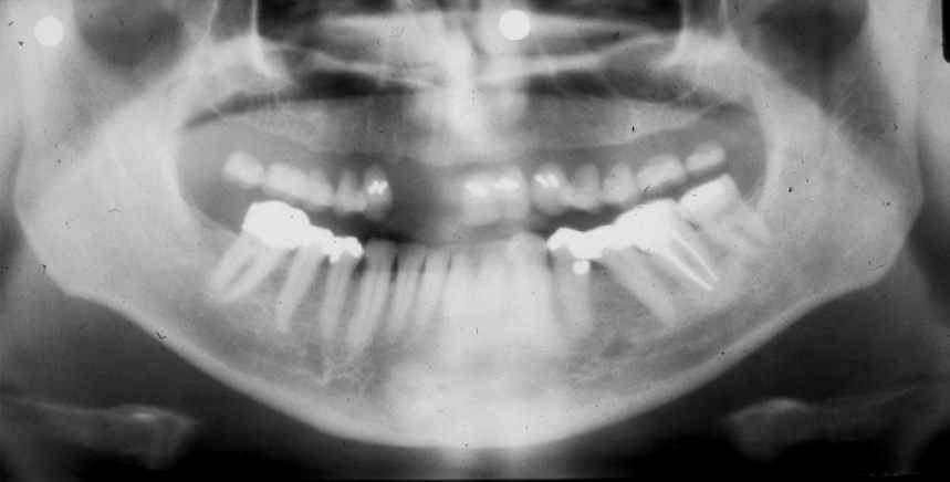 No eliminación de prótesis La dentadura total superior fue dejada en la boca.