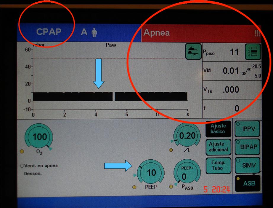Septiembre 2013 o bien manteniendo la conexión al respìrador y ventilando al paciente en Modo CPAP con 10 cm de H2O en aquellos casos que dispongamos de un modelo de respirador que nos lo permita