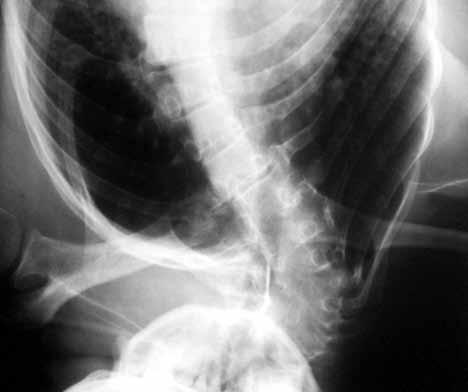 En una radiografía de la columna cervical y torácica se observó la presencia de hemivértebras y escoliosis y una audiometría tonal y con potenciales evocados auditivos de tallo cerebral, se le