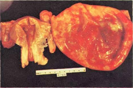 HALLAZGOS DE AUTOPSIA DEL CASO ANATOMOCLINICO Dr. Virgilio Cardona L.: La paciente tenía una masa enorme que correspondía a una tumoración quística de 18 x 12 cms. (Fig. 1) y que contenía 2.500 ce.