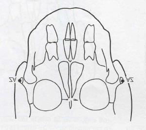 Fig N 10 Puntos ZA y AZ ZIGOMÁTICO 3.3.6.6 PLANOS DEL ANÁLISIS CEFALOMÉTRICO FRONTAL EN EL ESTUDIO Ancho maxilar Es la distancia entre los puntos JL y JR del análisis frontal de Ricketts.