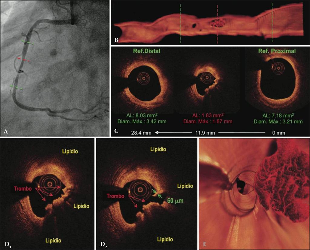 Martins Filho etal. OCT en el Abordaje de la Lesión Intermedia en la SCA 191 Figura 3. Pre procedimiento. Angiografía de la coronaria derecha (A).
