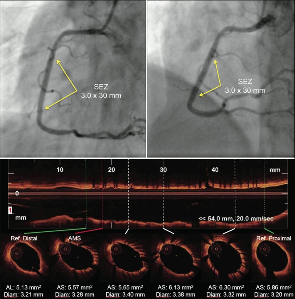 192 Martins Filho et al. OCT en el Abordaje de la lesión intermedia en la SCA Rev Bras Cardiol Invasiva. Figura 4. Pos procedimiento.