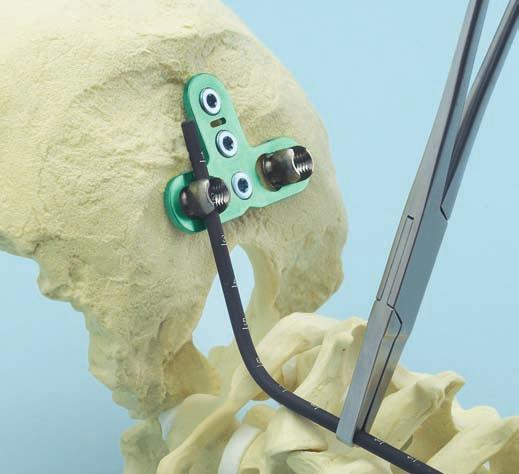 5 mm Moldee la barra de prueba para que se ajuste a la anatomía y para que se asiente completamente en los tornillos óseos.