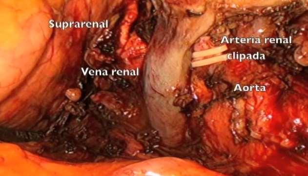 muestra tumor renal