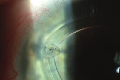 Use of intracorneal ring segments 163 Intacs implantation. 33 Carrasquillo et al. found an 81% of increase in contact lens tolerance after Intacs implantation in keratoconus and post-lasik ectasia.