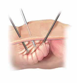 Durante la cirugía Se realizan entre 3 y 5 incisiones pequeñas en el abdomen. Se colocan tubos rígidos llamados puertos en las incisiones.