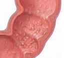 Pólipos y cáncer Los pólipos son crecimientos carnosos que se forman en el recubrimiento del colon. Con el paso del tiempo, los pólipos en el colon pueden crecer y convertirse en cancerosos.