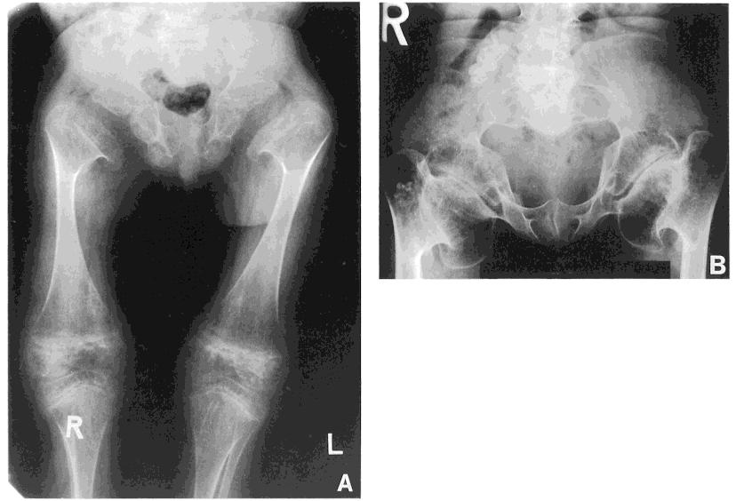 Kniest dysplasia Features different from SEDC: More involvement of trunk.