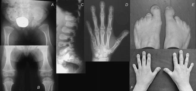 Spondyloperipheral dysplasia Features different from SEDC: Short stature less pronounced Short hands / feet (metacarpals /
