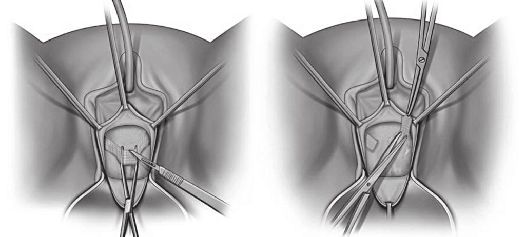 Complicaciones de las cintas suburetrales sintéticas en el tratamiento de la incontinencia urinaria de esfuerzo 2. Lesión uretral Es menos común que la vesical, pero más compleja.