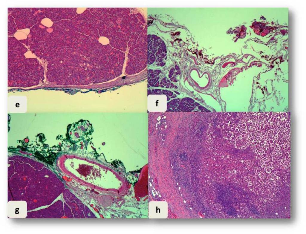 Fig. 8: Estudio anatomo-patológico del caso presentado en figura 7. (e) coloración HE: margen pancreático libre.