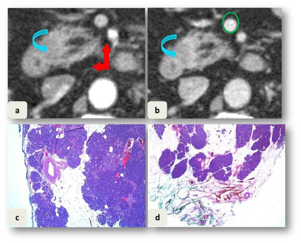 Fig. 2: (a) corte axial en fase pancreática y (b) corte axial en fase portal evidenciado una lesión hipodensa en la cabeza de páncreas que no afecta los planos grasos adyacentes a vasos ni espacio