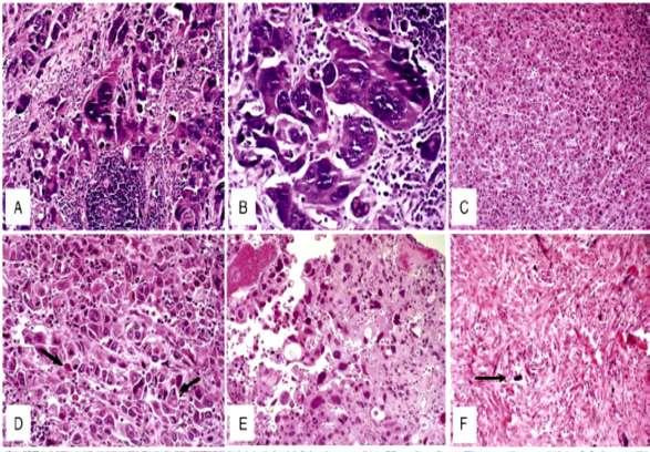 Carcinoma indiferenciado/pleomórfico de celulas gigantes Variante agresiva de carcinoma urotelial 8 casos (2009) y 13 casos (2016) Forma extrema de desdiferenciación Células grandes anaplásicas
